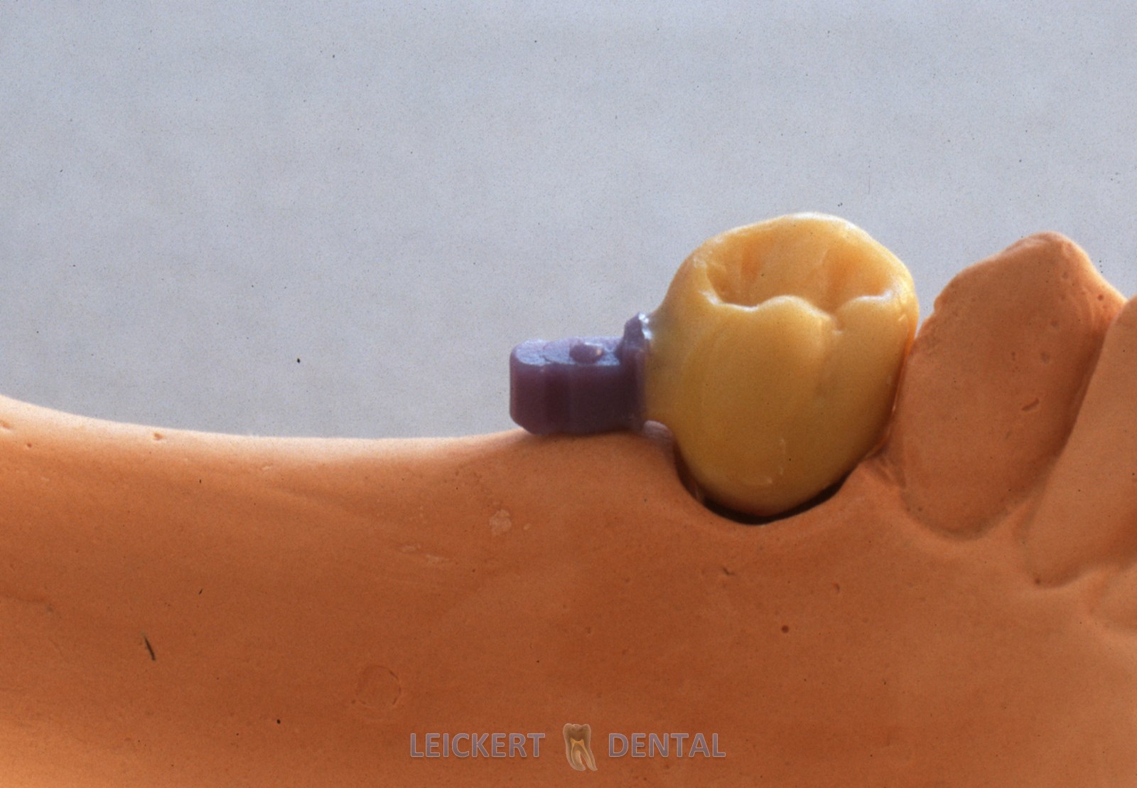 LEICKERTDENTAL Laser weld joints by al dente for tension and